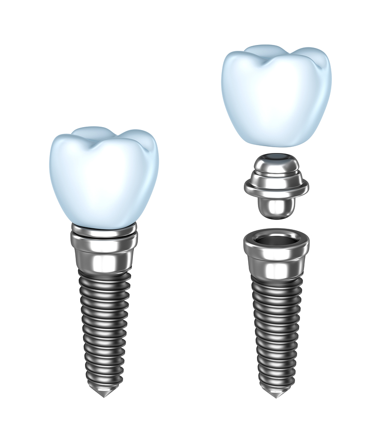 Dental Implants | Dentist in Columbia, SC | Smith Family Dentistry